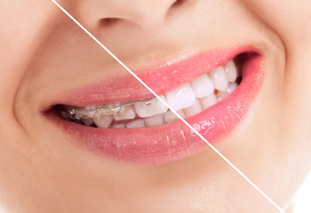 Ceramic Braces vs Invisalign For Better or for Worse? Knowledge for