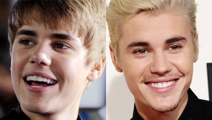 celebrity braces